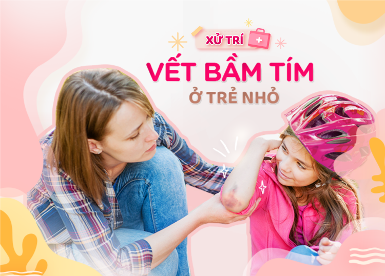 XỬ TRÍ VẾT BẦM TÍM Ở TRẺ NHỎ