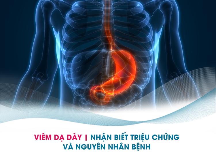 Viêm Dạ Dày – Triệu Chứng, Nguyên Nhân và Cách Điều Trị