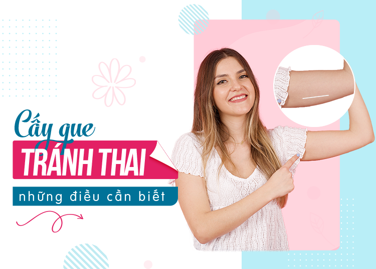 CẤY QUE TRÁNH THAI: NHỮNG ĐIỀU CẦN BIẾT