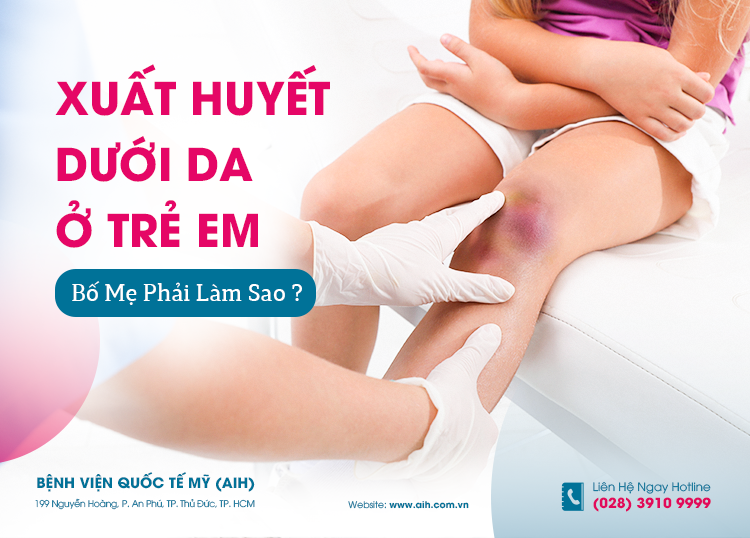 XUẤT HUYẾT DƯỚI DA Ở TRẺ EM, BỐ MẸ PHẢI LÀM SAO?
