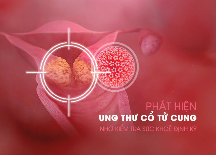 PHÁT HIỆN UNG THƯ CỔ TỬ CUNG NHỜ KIỂM TRA SỨC KHOẺ ĐỊNH KỲ VÀ CẮT BỎ KHỐI U KỊP THỜI TẠI BỆNH VIỆN QUỐC TẾ MỸ (AIH)