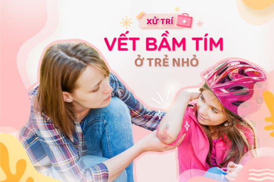 XỬ TRÍ VẾT BẦM TÍM Ở TRẺ NHỎ